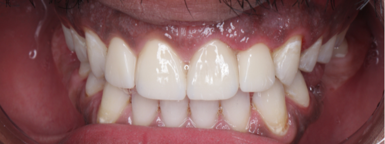 After image