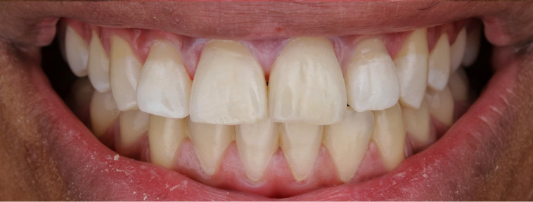 After image