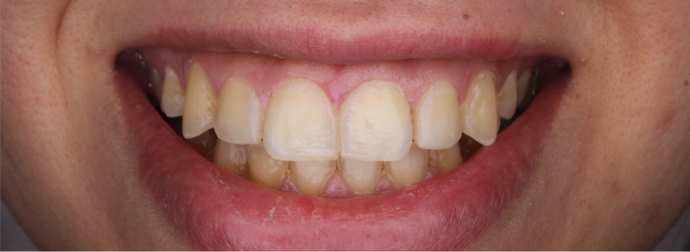 After image