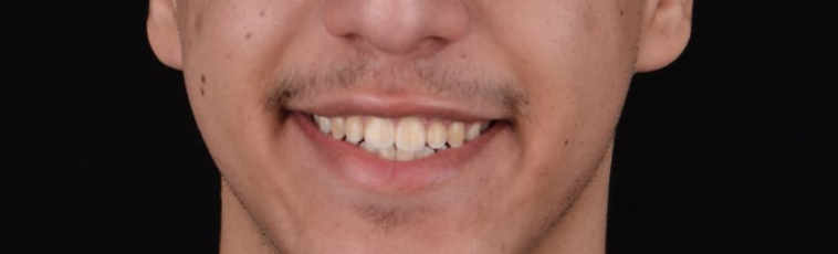 After image