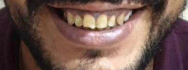 After image